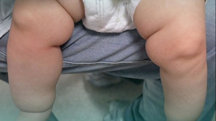 ลูกน้อยมี “สายรัดเยื่อหุ้มทารก” อยู่เต็มขาทั้งสองข้าง? คุณหมอบอก: ไม่ใช่ ถ้ามีปัญหาให้มาหาหมอเลย!