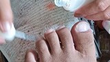 Satisfying to watch dirty toe nails (Toe Nails Cleaning)