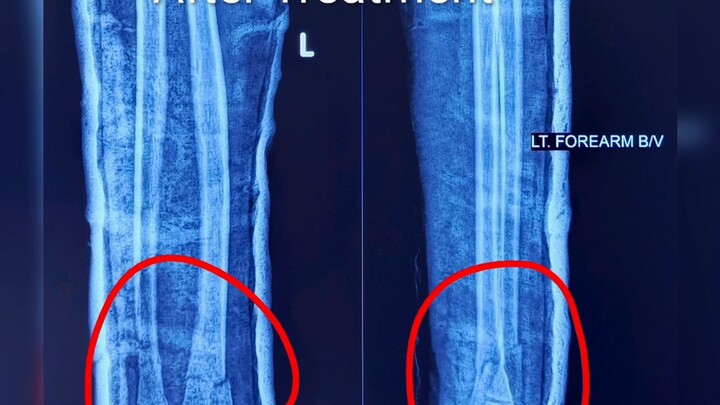 Radius-Ulna Forearm Fracture: Before vs After Treatment | Complete Explanation of Fracture Alignment
