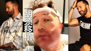 胡须移植（密恐慎入⚠️）