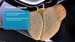 Prostate Cancer Animation