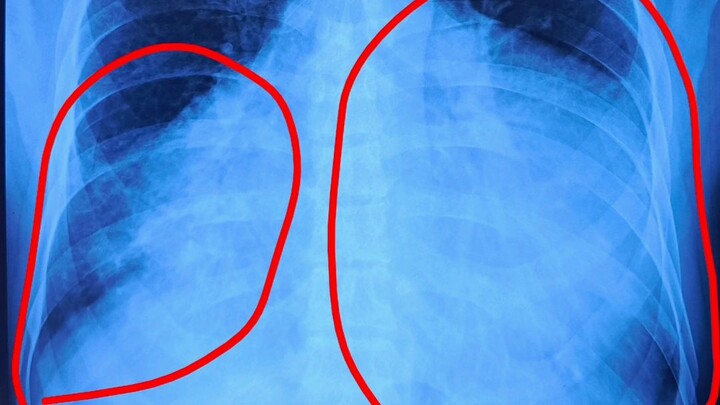 "Complete Radiological Analysis: Bilateral Opacity and Costophrenic Angle Blunting on Chest X-ray
