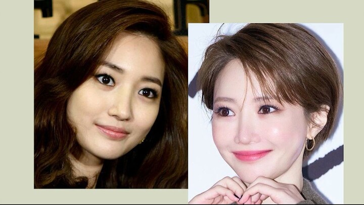 从高准熹的面部变化看：短缩颌与中庭比例问题