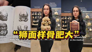 Bạn có biết căn bệnh xương hiếm gặp "phì đại xương kiểu mặt sư tử" này không?