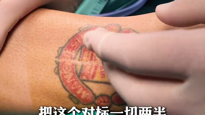 “การผ่าตัดเย็บปะโลโก้แมนยู”