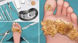 Immersive pedicure, surgical removal of large plantar warts animation