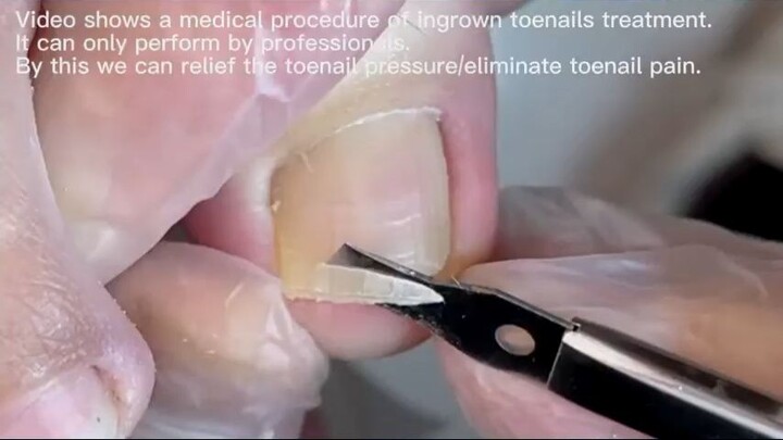 Never image the toenail can be so thick - Copy_R