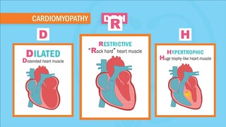 Cardiomyopathy