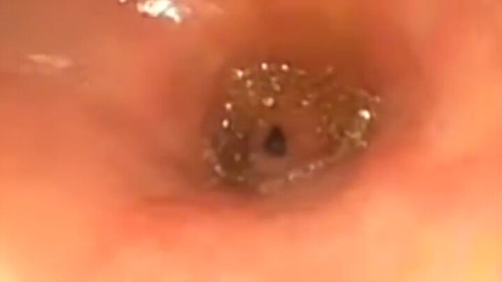 هكذا ترتدُّ العصارة الصفراوية إلى المعدة