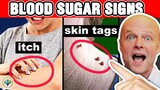 10 Alarming Signs Your Blood Sugar Is Too High