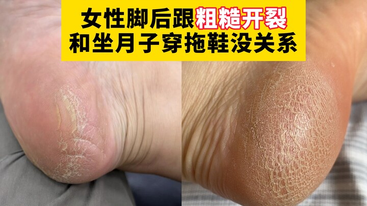 【科普】这种像裹了“砂纸”的后脚跟，袜子床单都给磨勾丝了，这不是普通干燥，而是角化型脚气，会传染！！