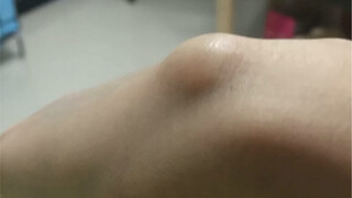 Five-year ganglion cyst cure