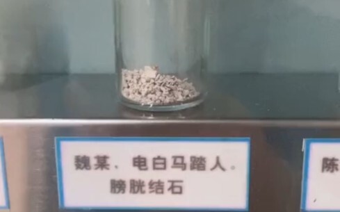 医院里的结石展示