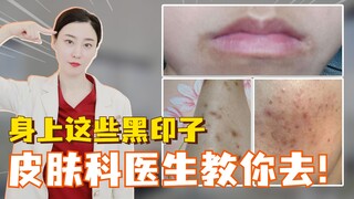Dokter kulit akan mengajari Anda cara menghilangkan noda hitam di tubuh ini!
