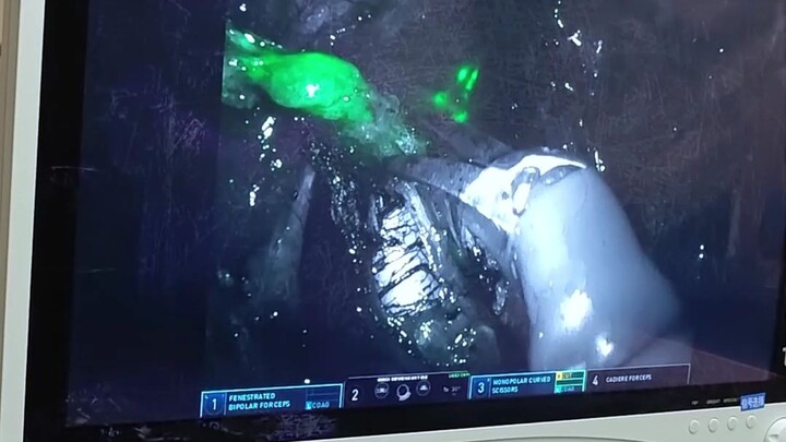 Bác sĩ phát hiện tế bào ung thư đã di căn hay chưa bằng cách nào?