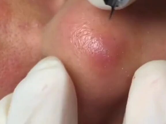 The feeling when you pop an inflamed pimple on your nose