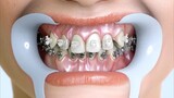 How Braces Straighten Your Teeth 🦷