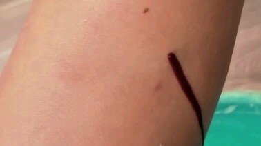 For urinary retention, stimulate the Yinlingquan point; for descending qi, use Zusanli to make urine