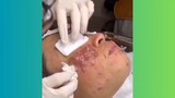 Popping Giant Pimple & Popping Huge Blackheads Best Pimple Popping Video
