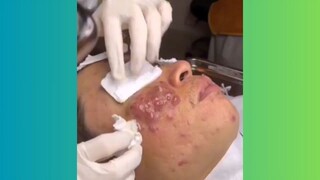 Popping Giant Pimple & Popping Huge Blackheads Best Pimple Popping Video