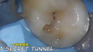 牙医小哥实拍清除“隐藏式”龋洞的全过程，看来看似正常的牙齿不一定健康