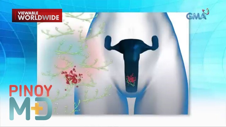 Yeast infection, paano maiiwasan? | Pinoy MD