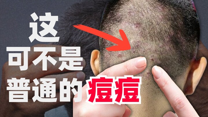 【สาระความรู้】อย่าแคะ! ระวังหัวล้าน! หนังศีรษะเป็นสิว บวมแดงและเจ็บ จะจัดการกับรูขุมขนอักเสบยังไงดี?