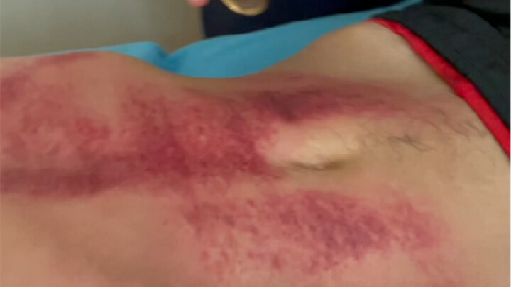 Cạo gió vùng bụng có hiệu quả rõ rệt trong việc tăng cường chức năng của ngũ tạng, đồng thời là giải