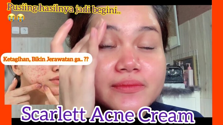 Scarlett Acne Cream Review| Review Acne Cream Scarlett | Acne Day Cream Scarlett
