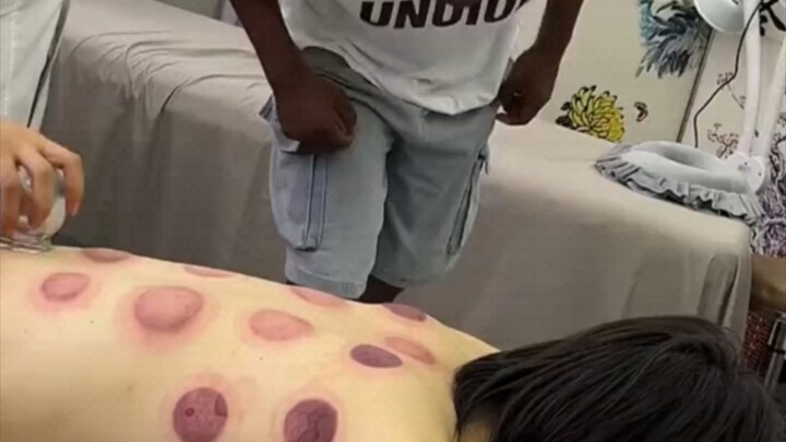 The black guy's cupping was light in color. He questioned the other party's lack of strength! The fa