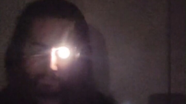 A netizen had one eye removed due to cancer, so he simply installed a "flashlight" artificial eye