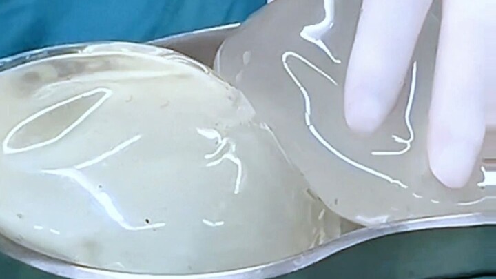 Cô gái nhỏ nhắn cao 160cm lại đặt túi ngực giả 450cc