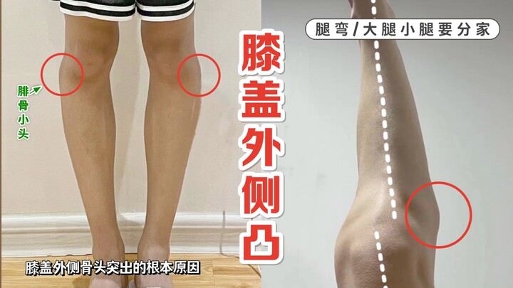 Lateral Knee Prominence/Fibular Head Protrusion (Thigh and Calf Need to Be Separated)