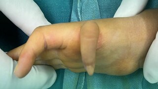 Jempol yang tadinya tidak bisa digerakkan kini bisa memegang pena untuk menulis, sang ibu berkata: h