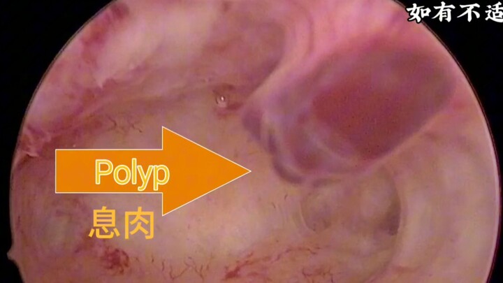 إزالة السلائل الرحمية بالقص