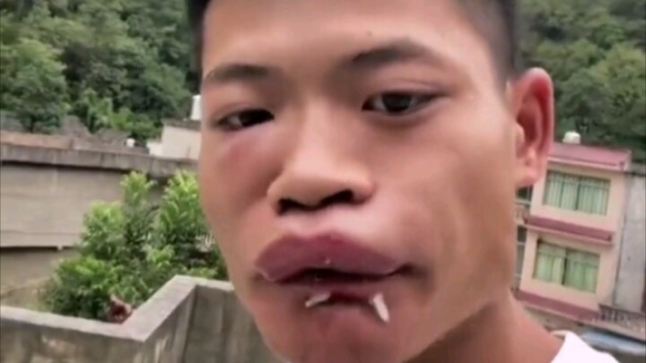 Wang Can: Sudah mengusik sarang tawon, siapa yang lebih banyak digigit hingga bengkak.