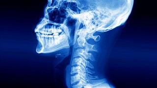 A man accidentally swallowed wireless headphones and this is what happened to his esophagus.
