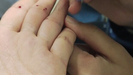 The senior TCM students running the free clinic at school are so awesome!! I’m super brave too!!