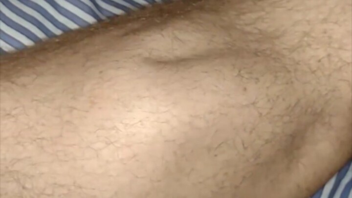 تشنج حاد في الساق