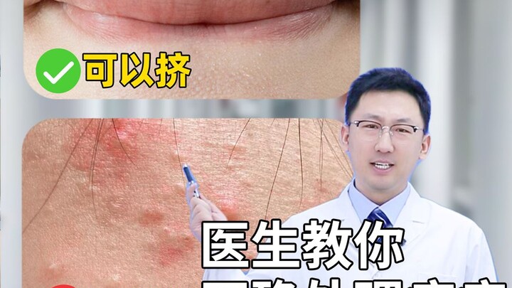 Jangan sekali-kali memencet jerawat ini! Dokter ajari cara membedakannya!