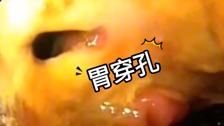 مذهل! جرأة إصلاح ثقب المعدة تحت المنظار المعدي!