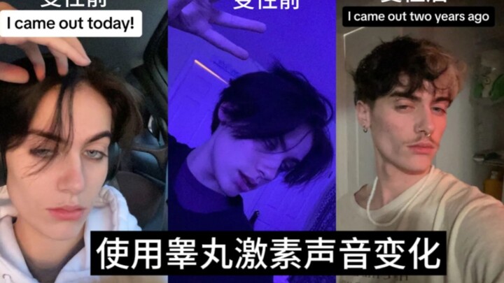 Chuyển giới từ nữ sang nam: Ghi lại những thay đổi sau hai năm dùng hormone nam