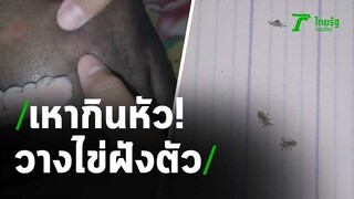 สยองเหากินหัว! วางไข่ฝังตัว | 12-03-64 | ไทยรัฐนิวส์โชว์