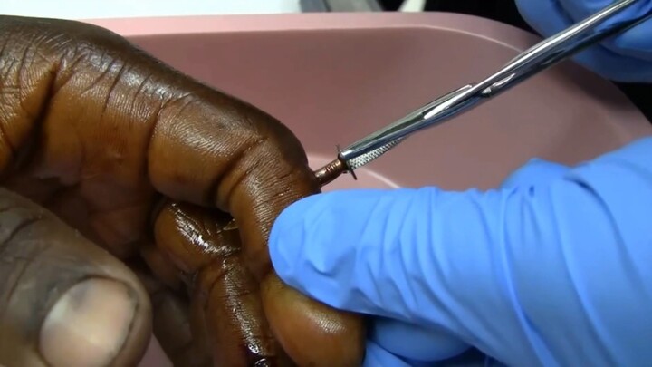 It Hurts So Much! Worker’s Finger Pierced by Nail—Doctor Helps Remove It!