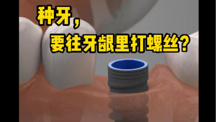 Dental implants require screws to be inserted into the alveolar bone—let's take a look at the entire