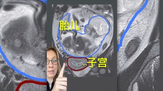 被胎儿恐怖的寄生能力吓到‼️