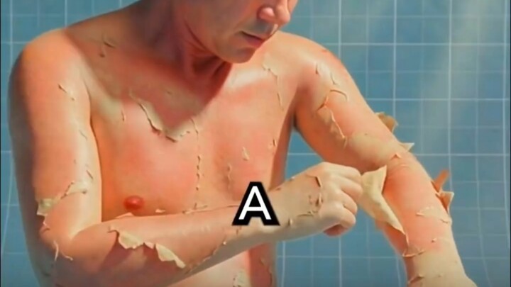 เมื่อผิวหนังถูกแดดเผา แท้จริงแล้วผิวไม่ได้ถูก “ไฟไหม้” เลย