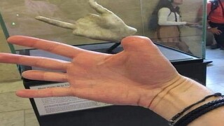 คุณหัวเราะ คุณทำนิ้วหาย