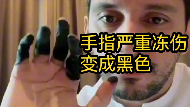 นิ้วมือที่ถูกความเย็นจัดจนเป็นแผลรุนแรงจะกลายเป็นสีดำใช่ไหม?