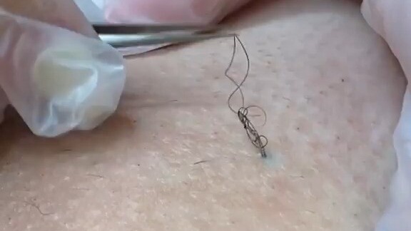 Ingrown hairs